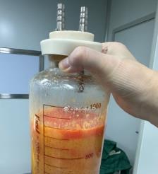 枣阳水动力吸脂手术要做多久？
